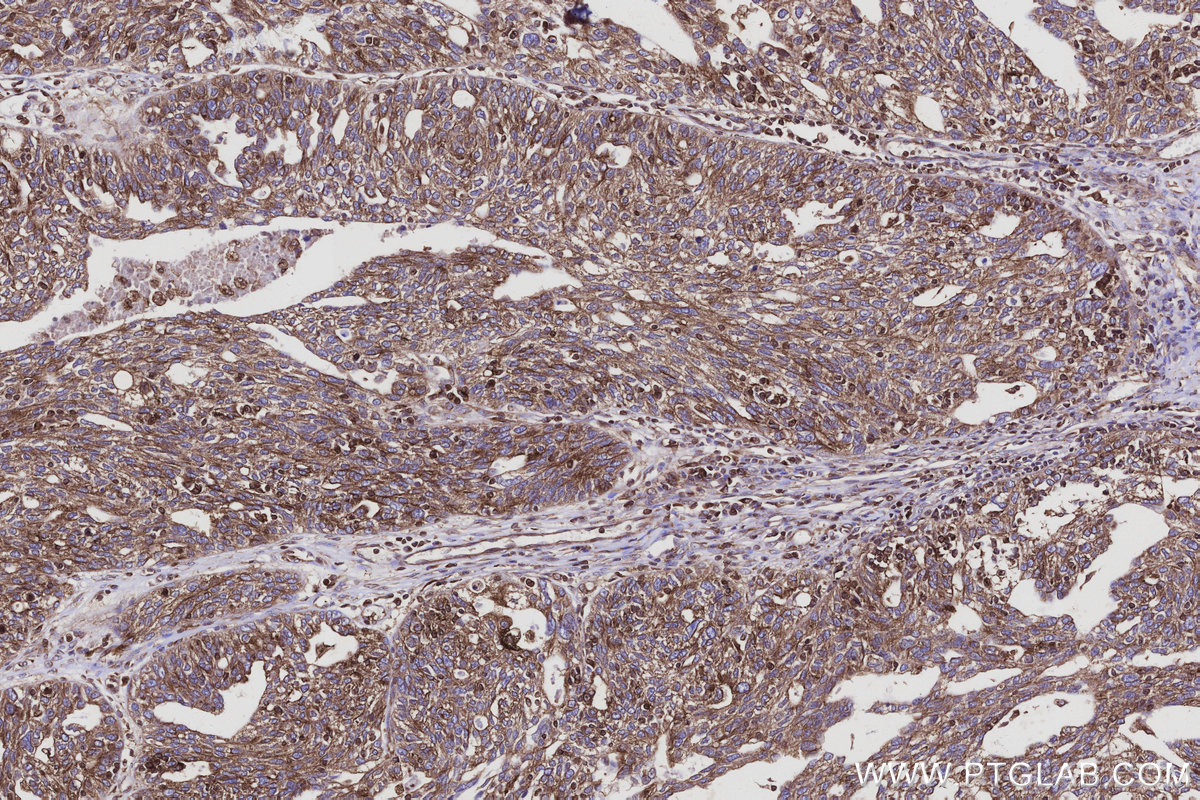 IHC staining of human ovary cancer using 20788-1-AP