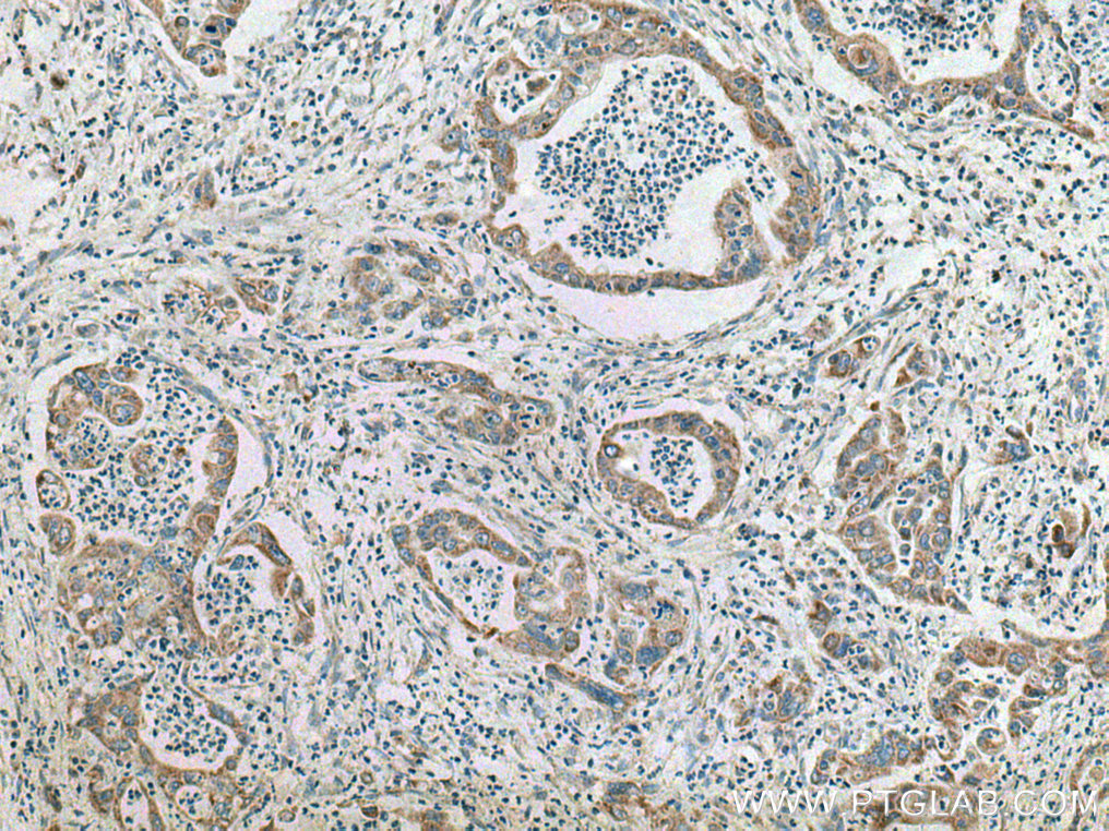 IHC staining of human pancreas cancer using 10217-1-AP