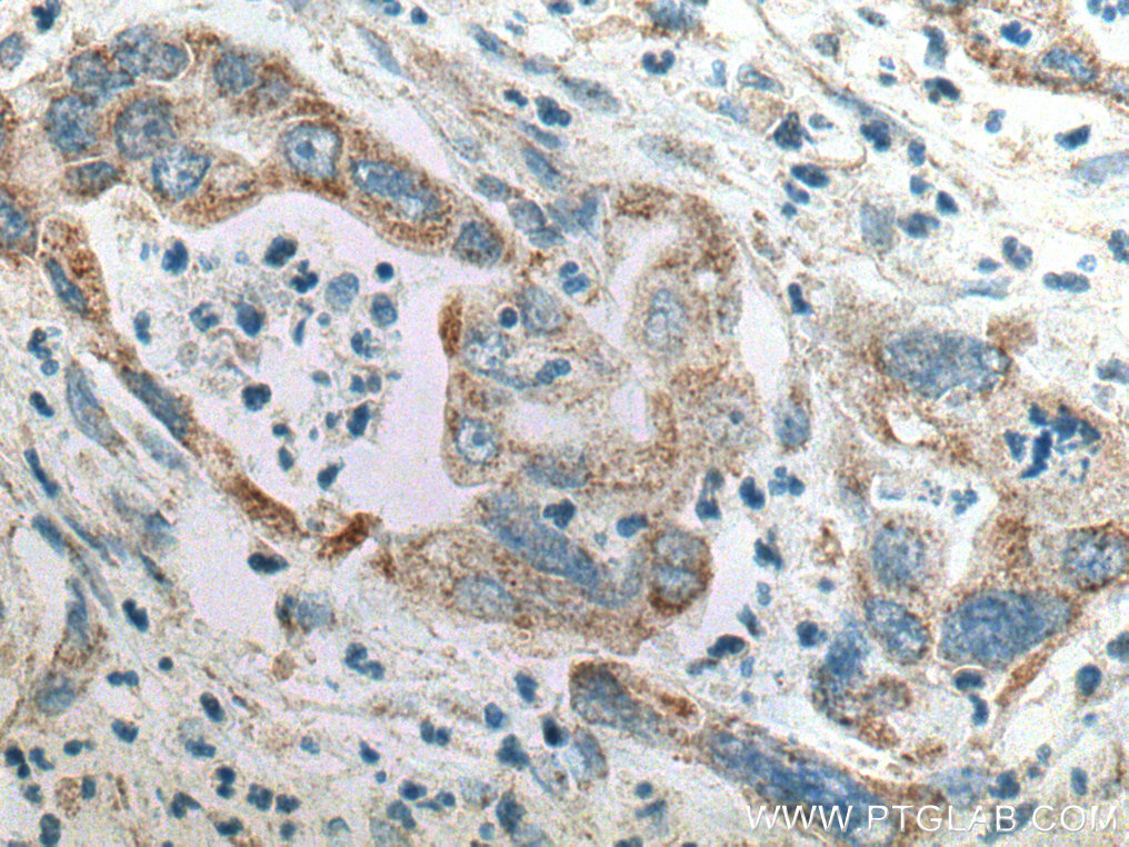 IHC staining of human pancreas cancer using 10217-1-AP