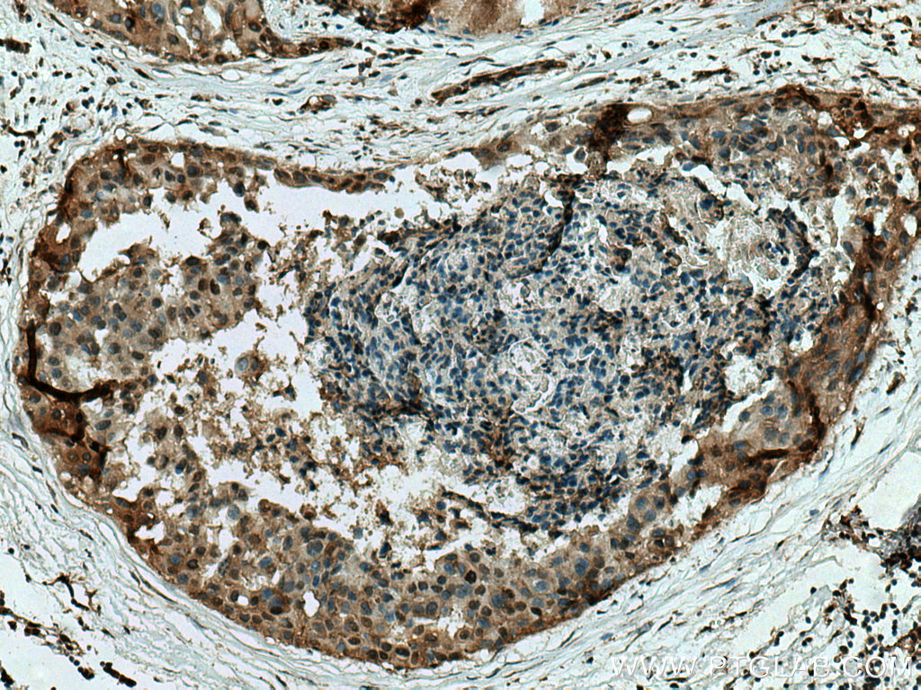 IHC staining of human breast cancer using 13949-1-AP