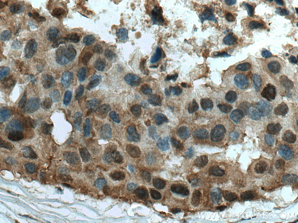 IHC staining of human breast cancer using 13949-1-AP