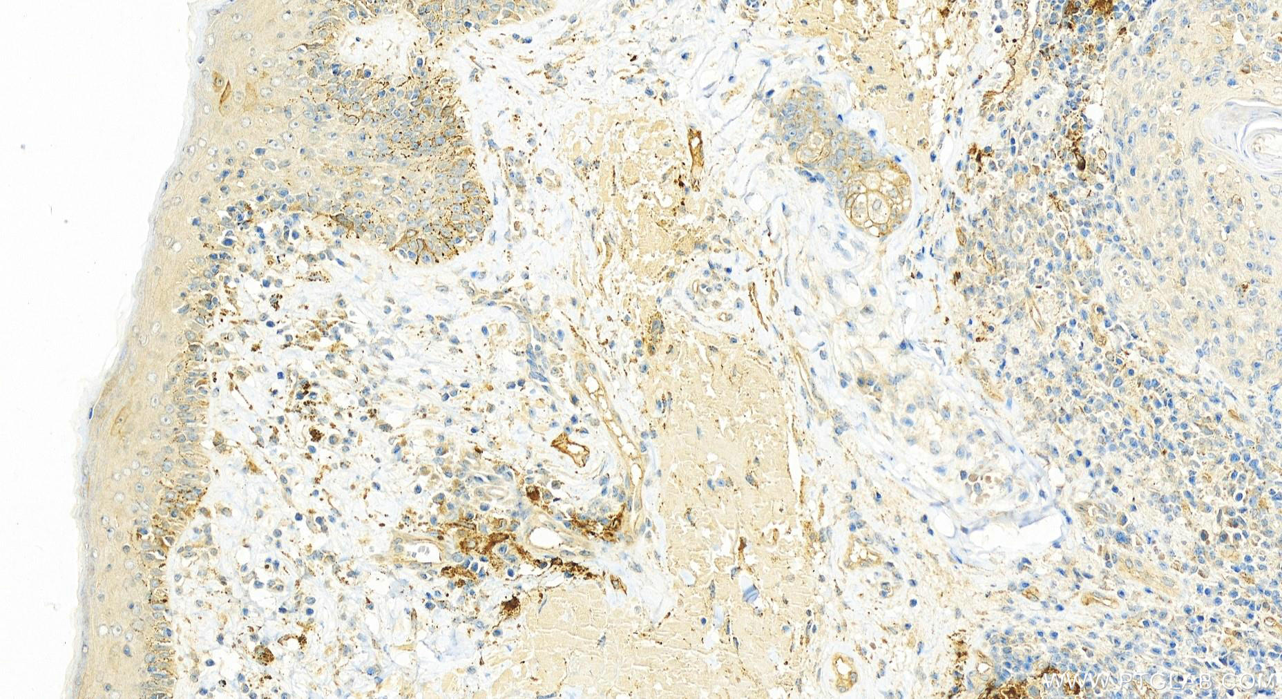 IHC staining of skin cancer using 14124-1-AP