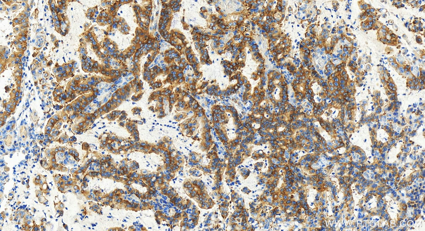 IHC staining of human stomach cancer using 83690-4-RR