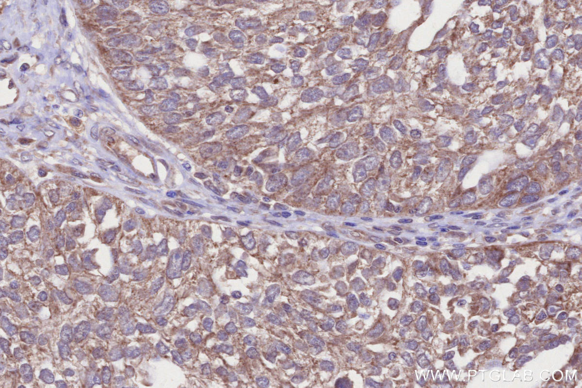 IHC staining of human ovary cancer using 13515-1-AP IHC staining of human ovary cancer using 13515-1-AP