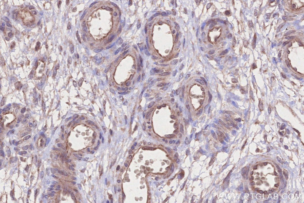 IHC staining of human ovary cancer using 13515-1-AP IHC staining of human ovary cancer using 13515-1-AP