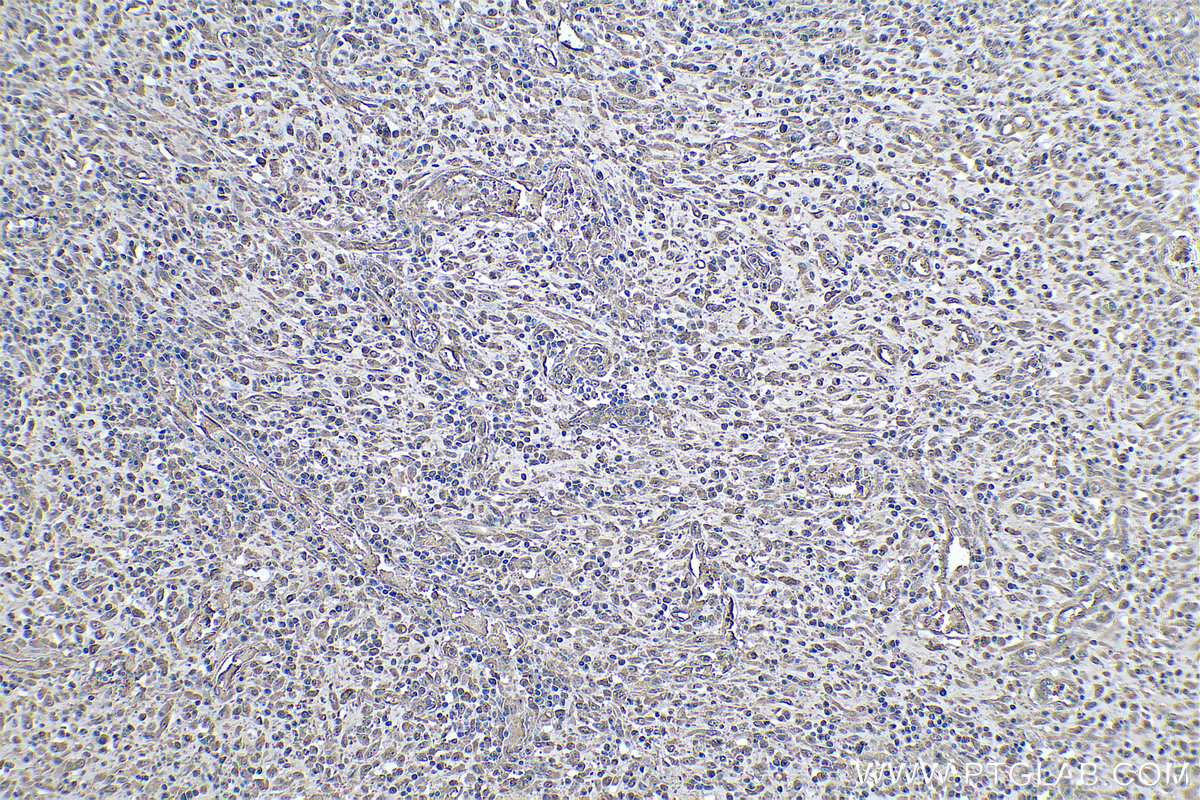 IHC staining of human colon cancer using 67643-1-Ig