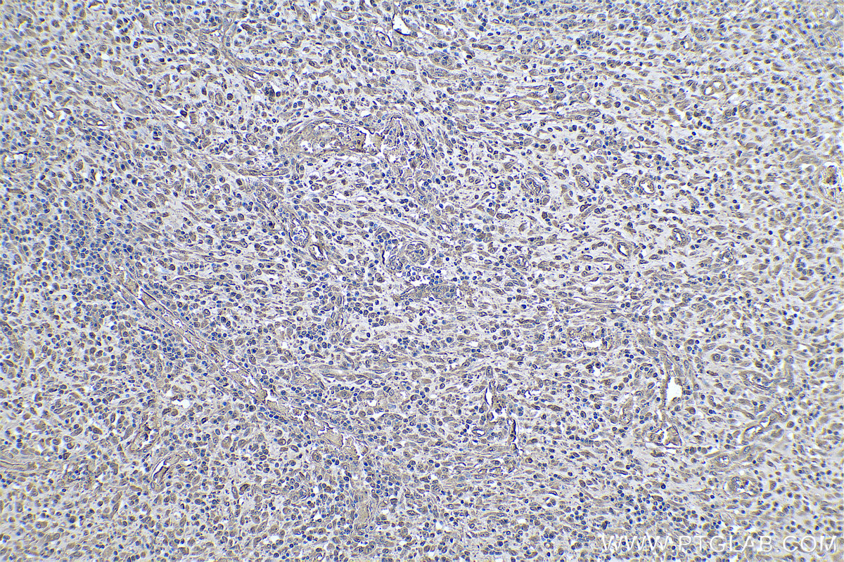 IHC staining of human colon cancer using 67643-1-Ig