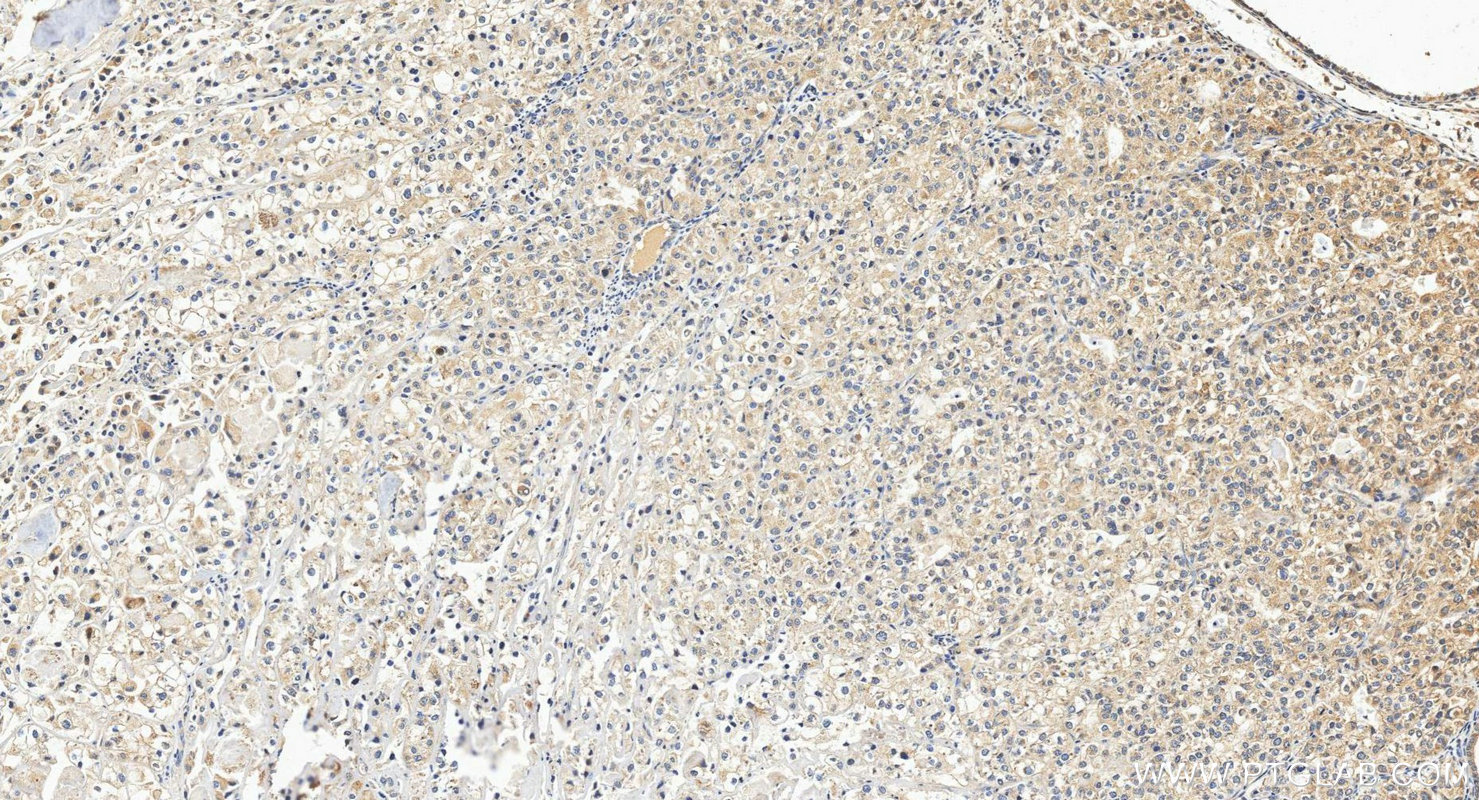 IHC staining of human endometrial cancer using 26873-1-AP