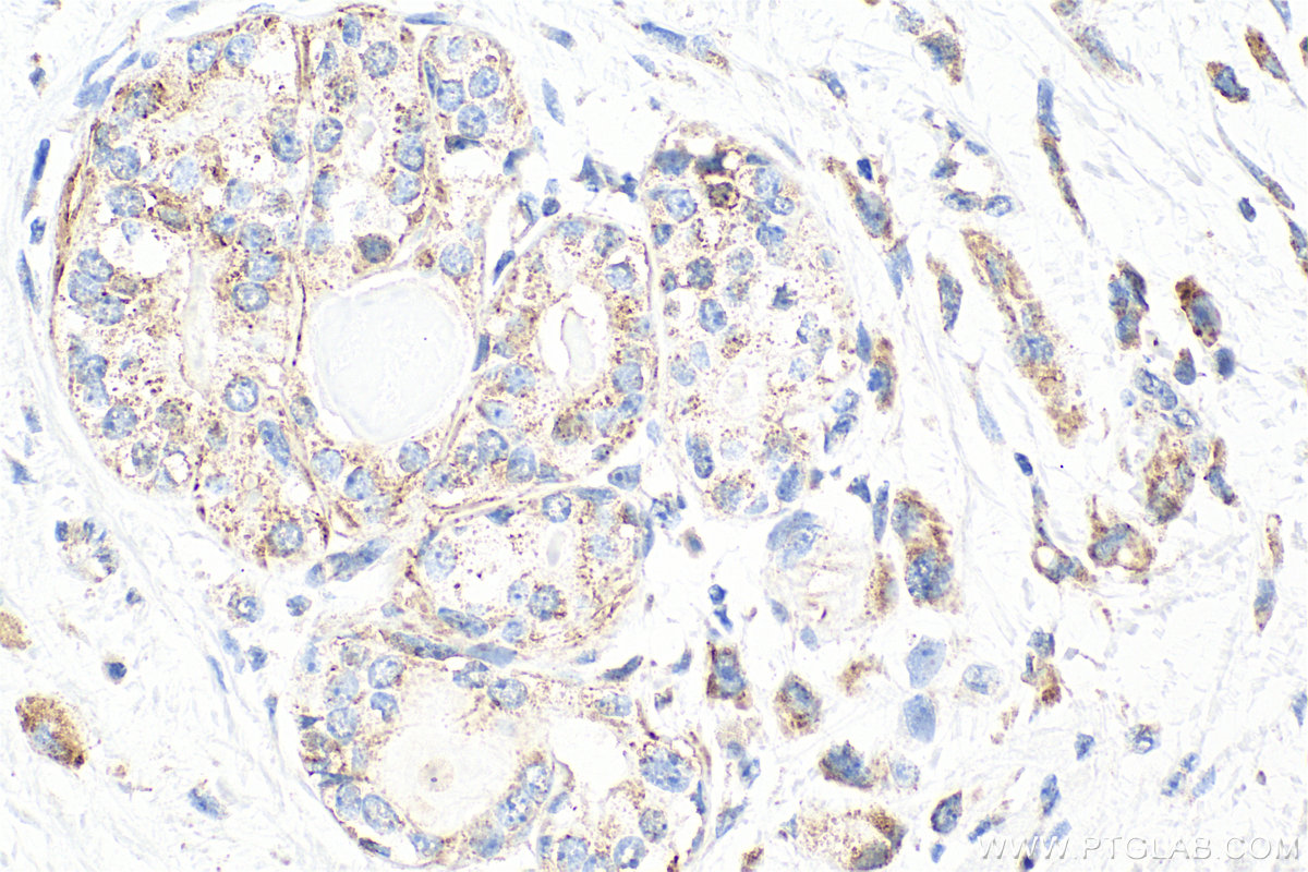 IHC staining of human breast cancer using 10082-2-AP