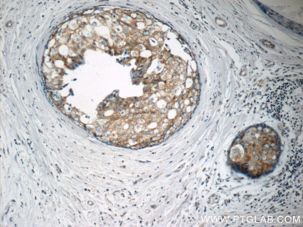 IHC staining of human breast cancer using 10082-2-AP