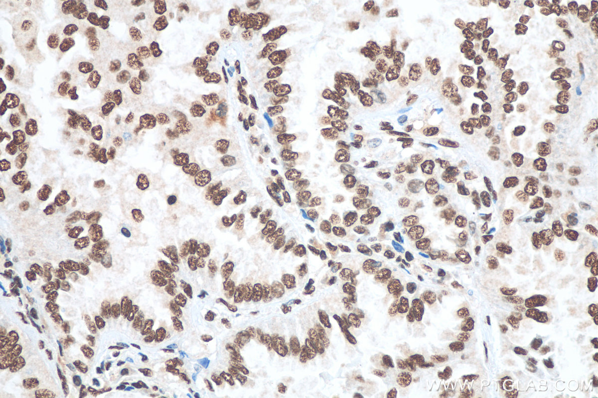 IHC staining of human lung cancer using 12202-2-AP