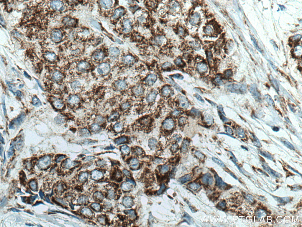 IHC staining of human breast cancer using 14341-1-AP