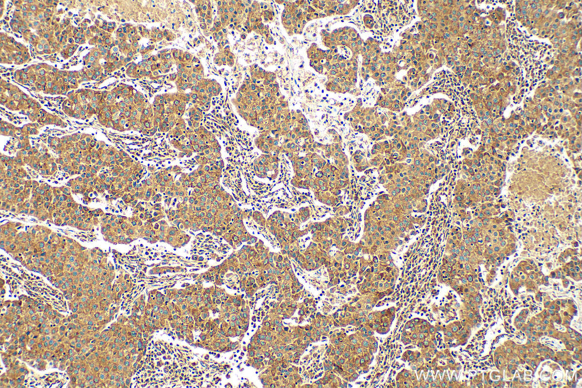 IHC staining of human breast cancer using 81910-1-RR