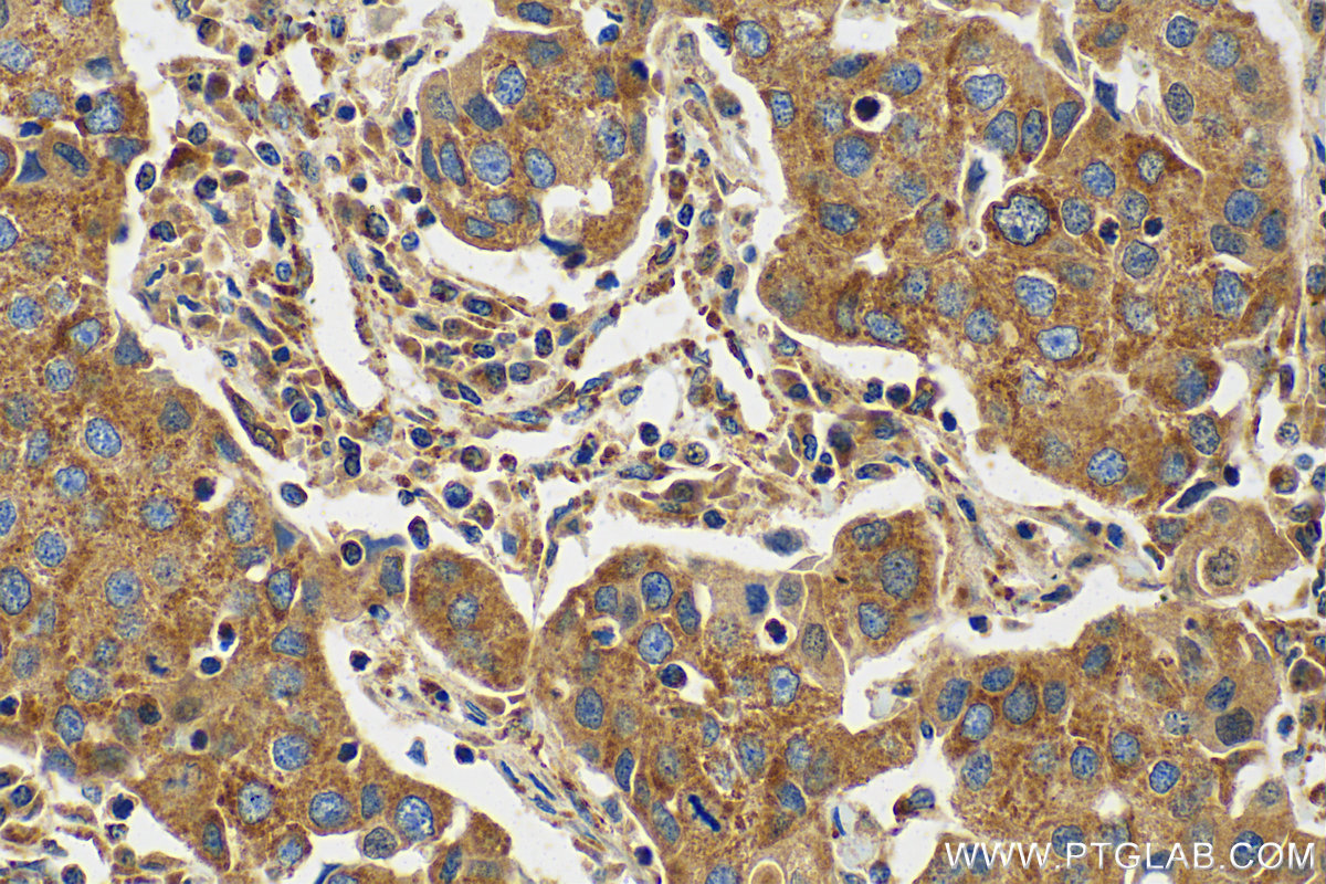 IHC staining of human breast cancer using 81910-1-RR