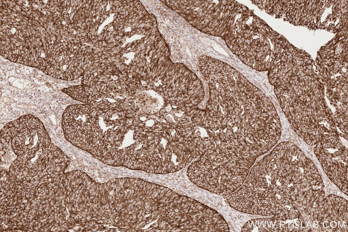 IHC staining of human ovary cancer using 81910-1-RR IHC staining of human ovary cancer using 81910-1-RR