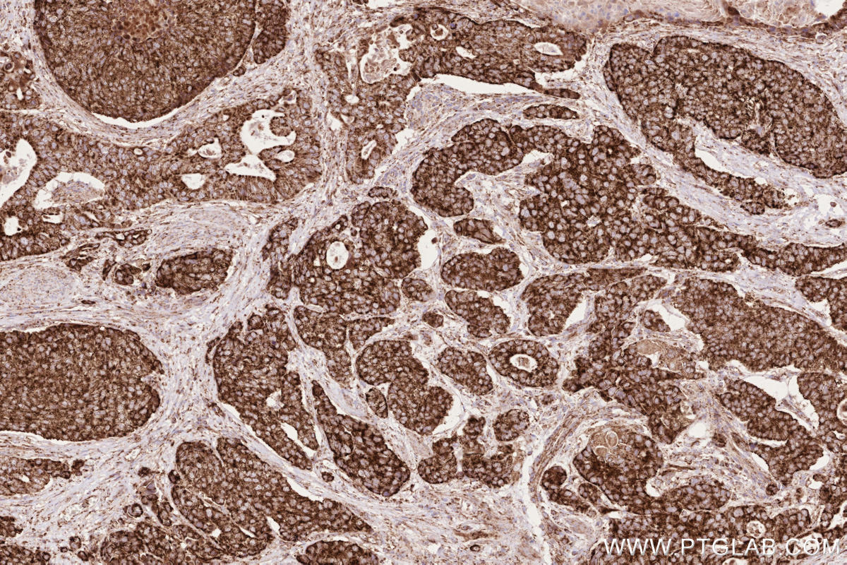IHC staining of human stomach cancer using 81910-1-RR IHC staining of human stomach cancer using 81910-1-RR