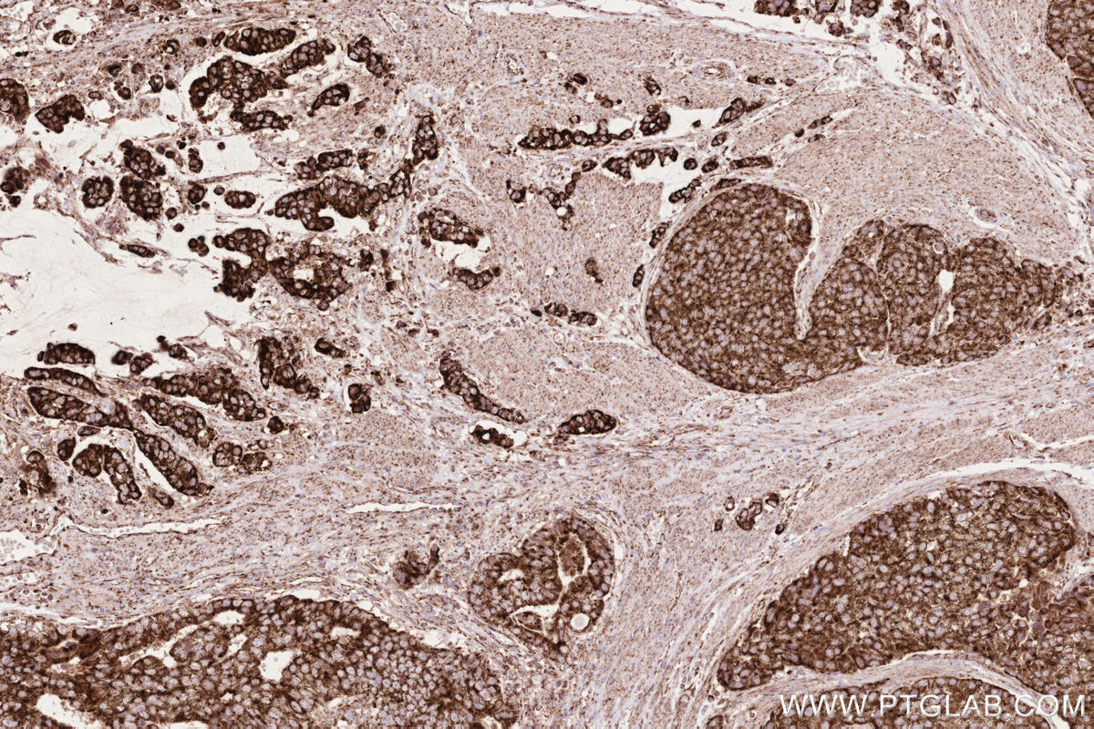 IHC staining of human stomach cancer using 81910-1-RR IHC staining of human stomach cancer using 81910-1-RR