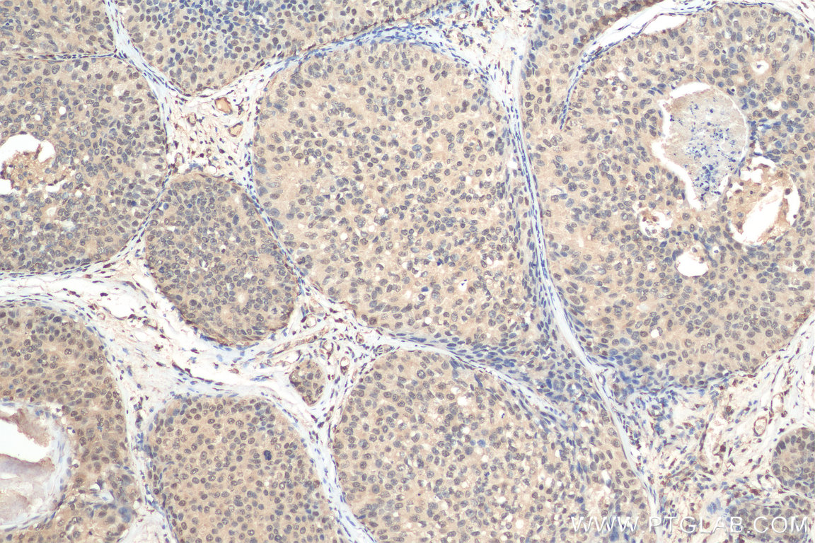 IHC staining of human breast cancer using 66837-1-Ig
