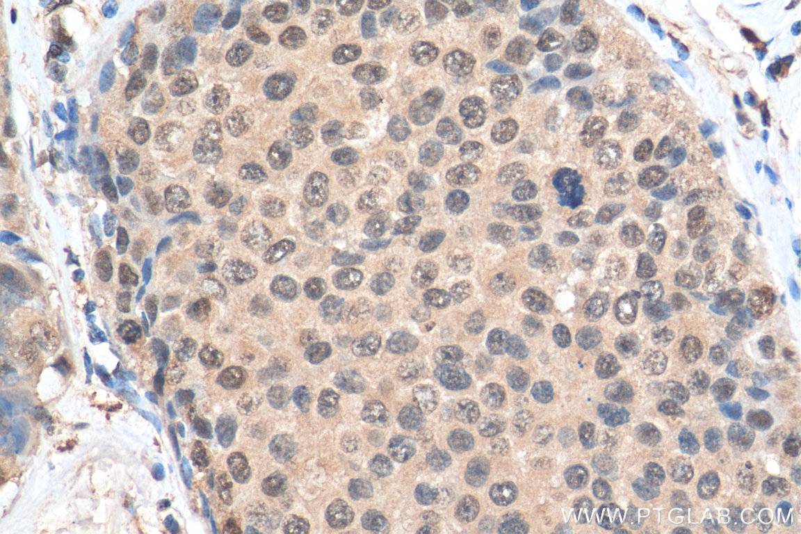 IHC staining of human breast cancer using 66837-1-Ig