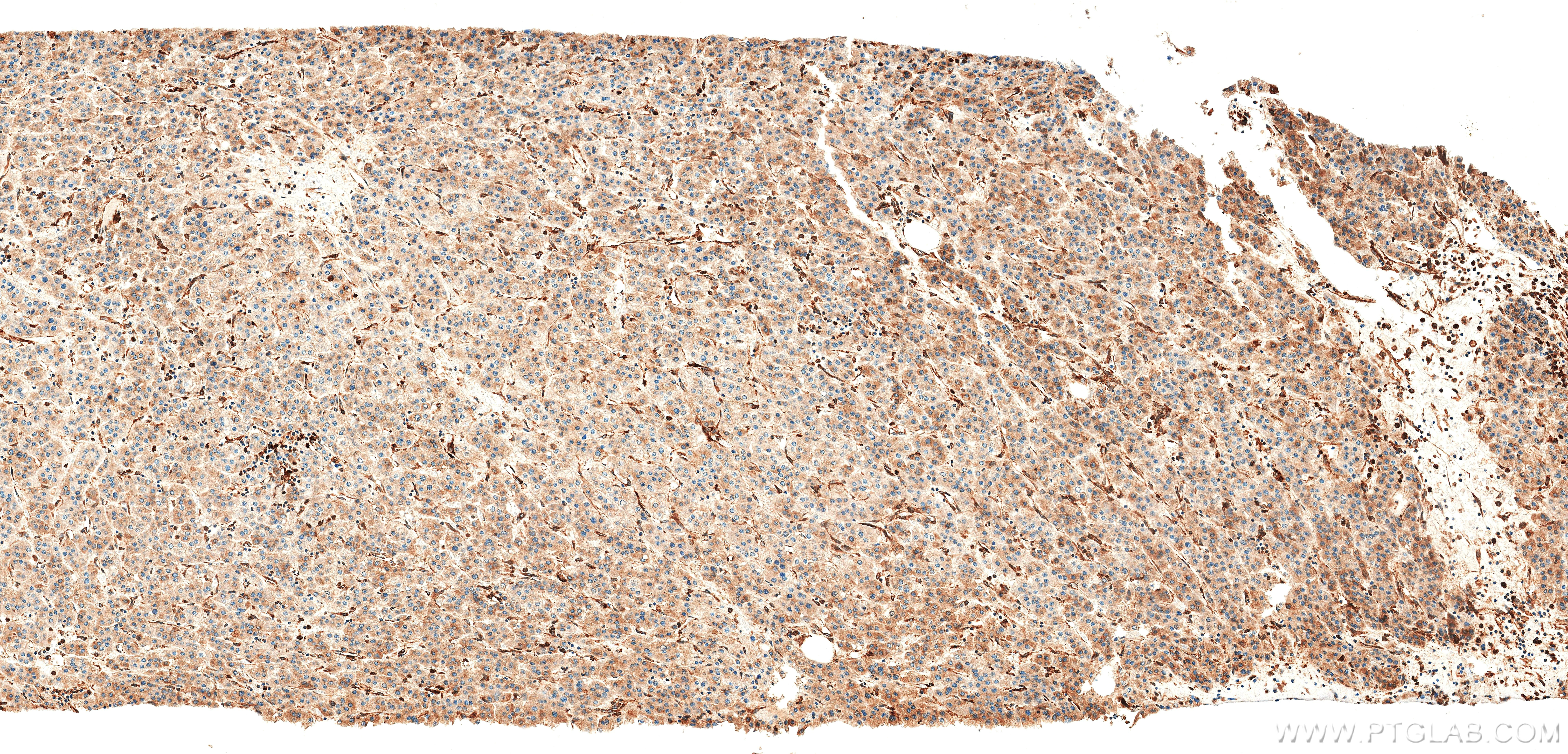 IHC staining of Human Hepatocellular cancer using 83546-3-PBS IHC staining of Human Hepatocellular cancer using 83546-3-PBS