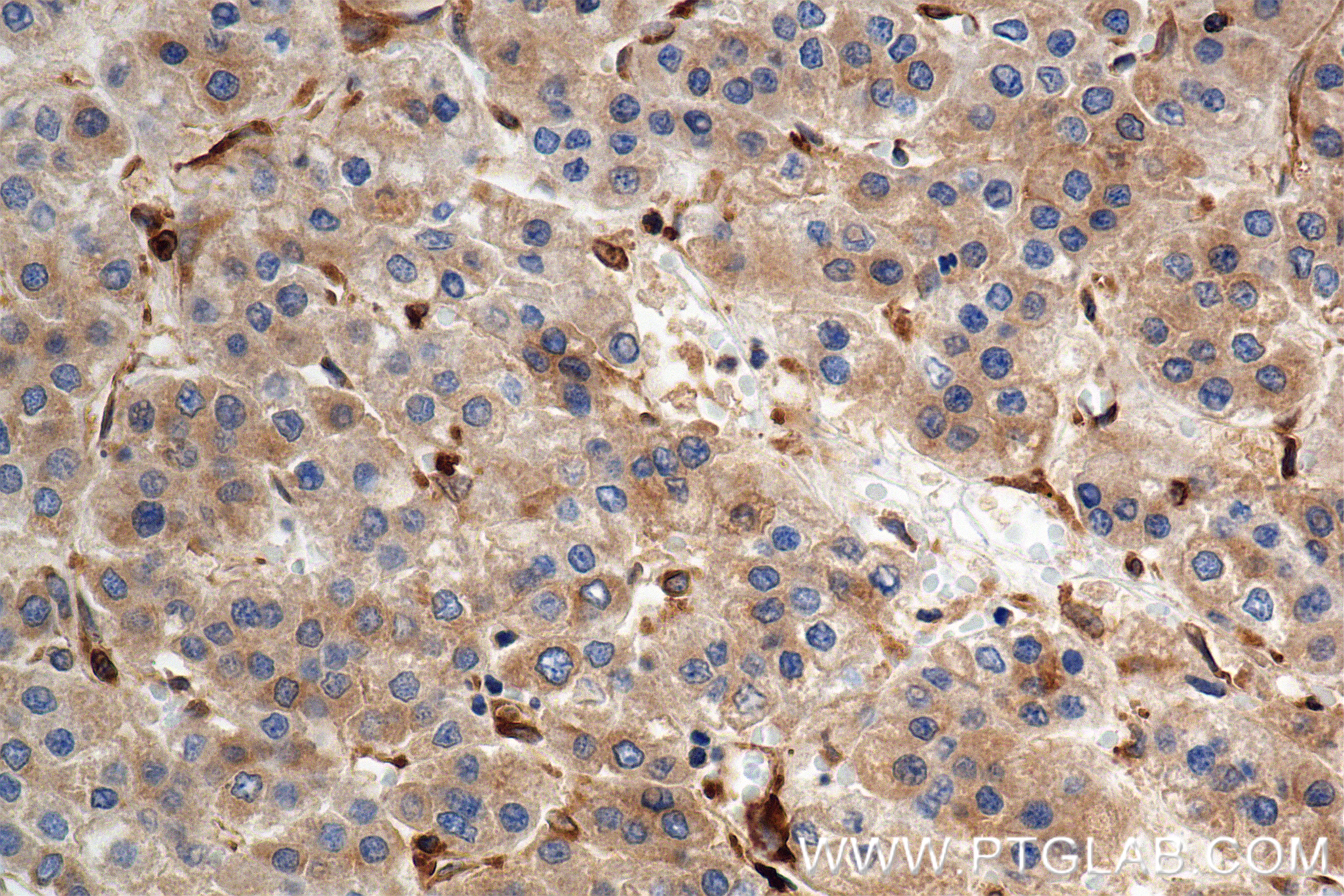 IHC staining of Human Hepatocellular cancer using 83546-3-PBS IHC staining of Human Hepatocellular cancer using 83546-3-PBS