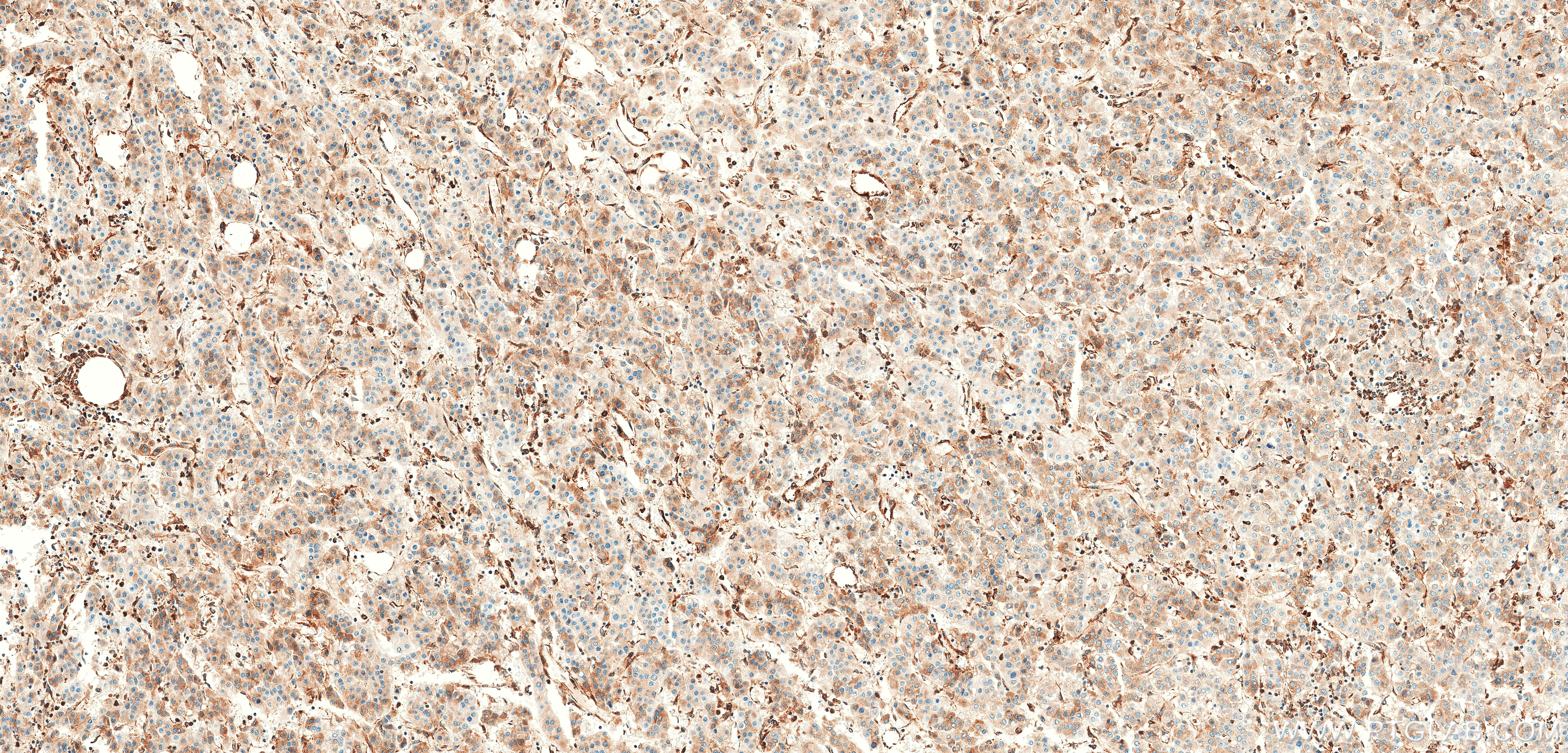 IHC staining of Human Hepatocellular cancer using 83546-3-RR