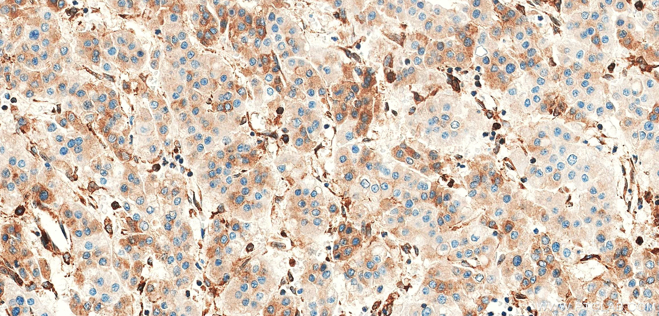 IHC staining of Human Hepatocellular cancer using 83546-3-RR