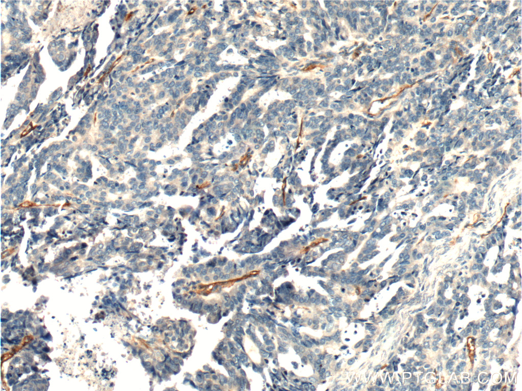 IHC staining of human ovary tumor using 17564-1-AP