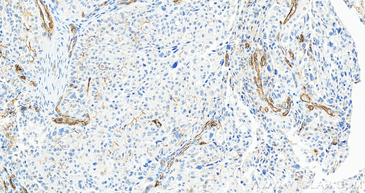 IHC staining of human ovary cancer using 17564-1-AP