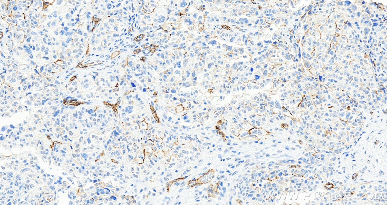 IHC staining of human ovary cancer using 17564-1-AP