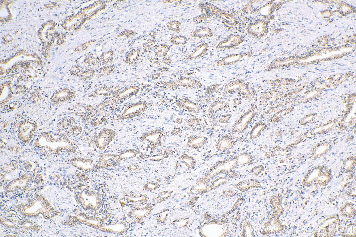 IHC staining of human prostate cancer using 11525-1-AP