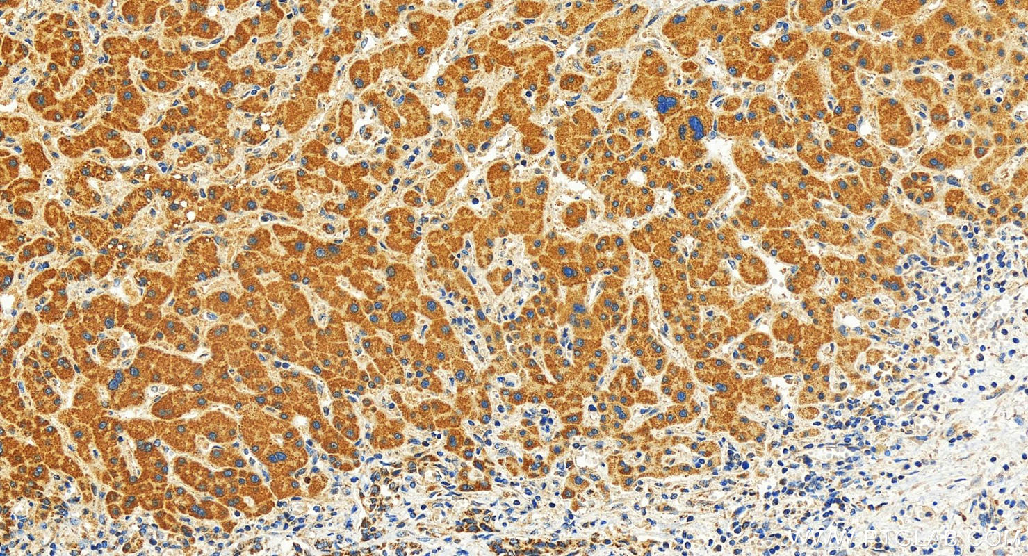 IHC staining of human intrahepatic cholangiocarcinoma using 30081-1-AP