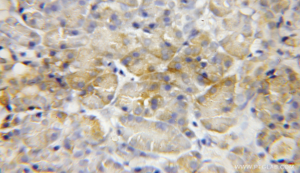 IHC staining of human pancreas cancer using 12117-1-AP