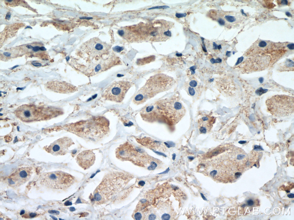 IHC staining of human breast cancer using 66026-1-Ig (same clone as 66026-1-PBS)