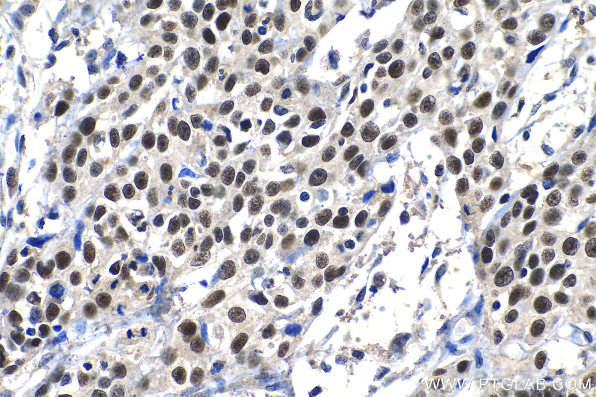 IHC staining of human cervical cancer using 10513-1-AP