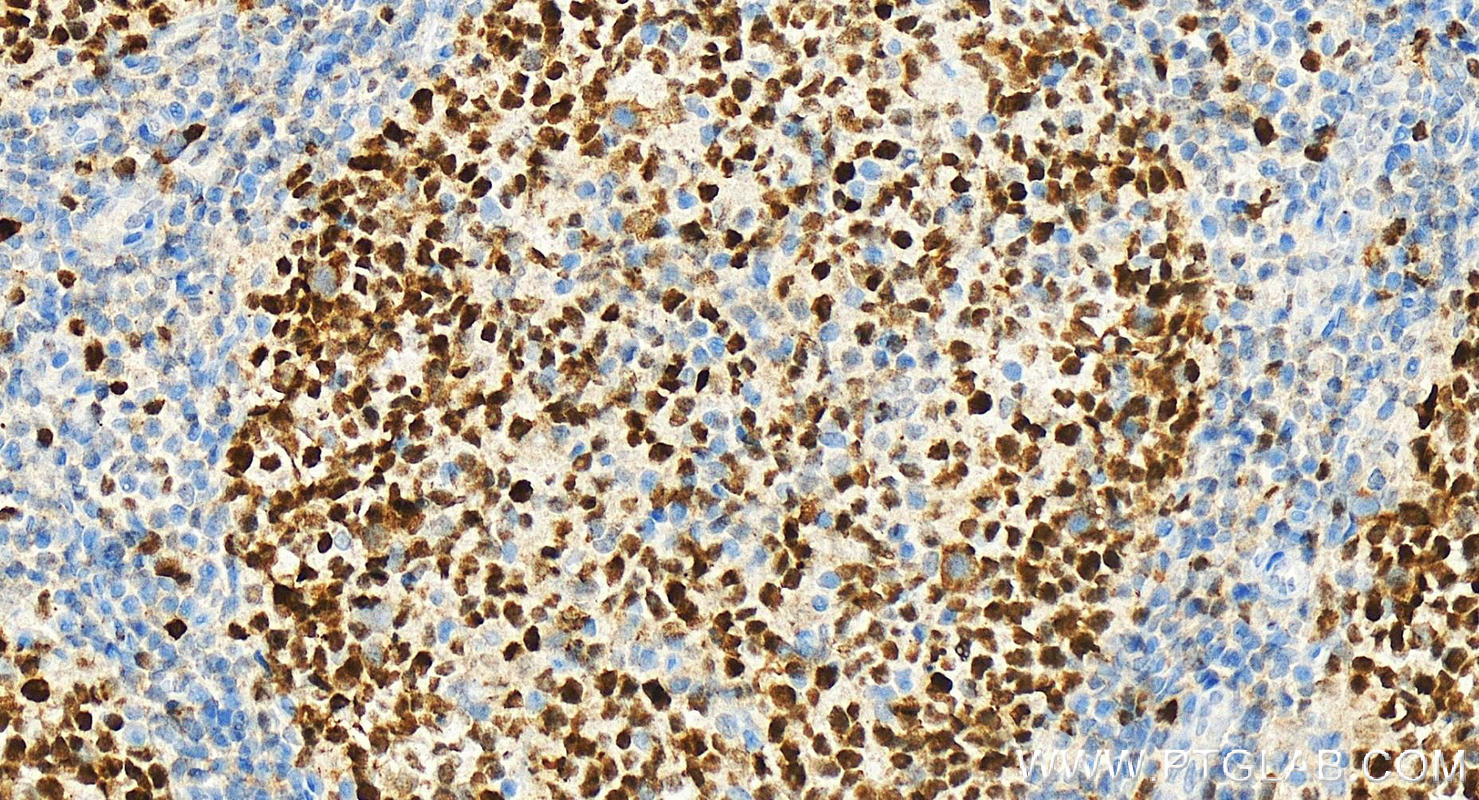 IHC staining of Human tonsillitis using 66204-1-Ig (same clone as 66204-1-PBS)