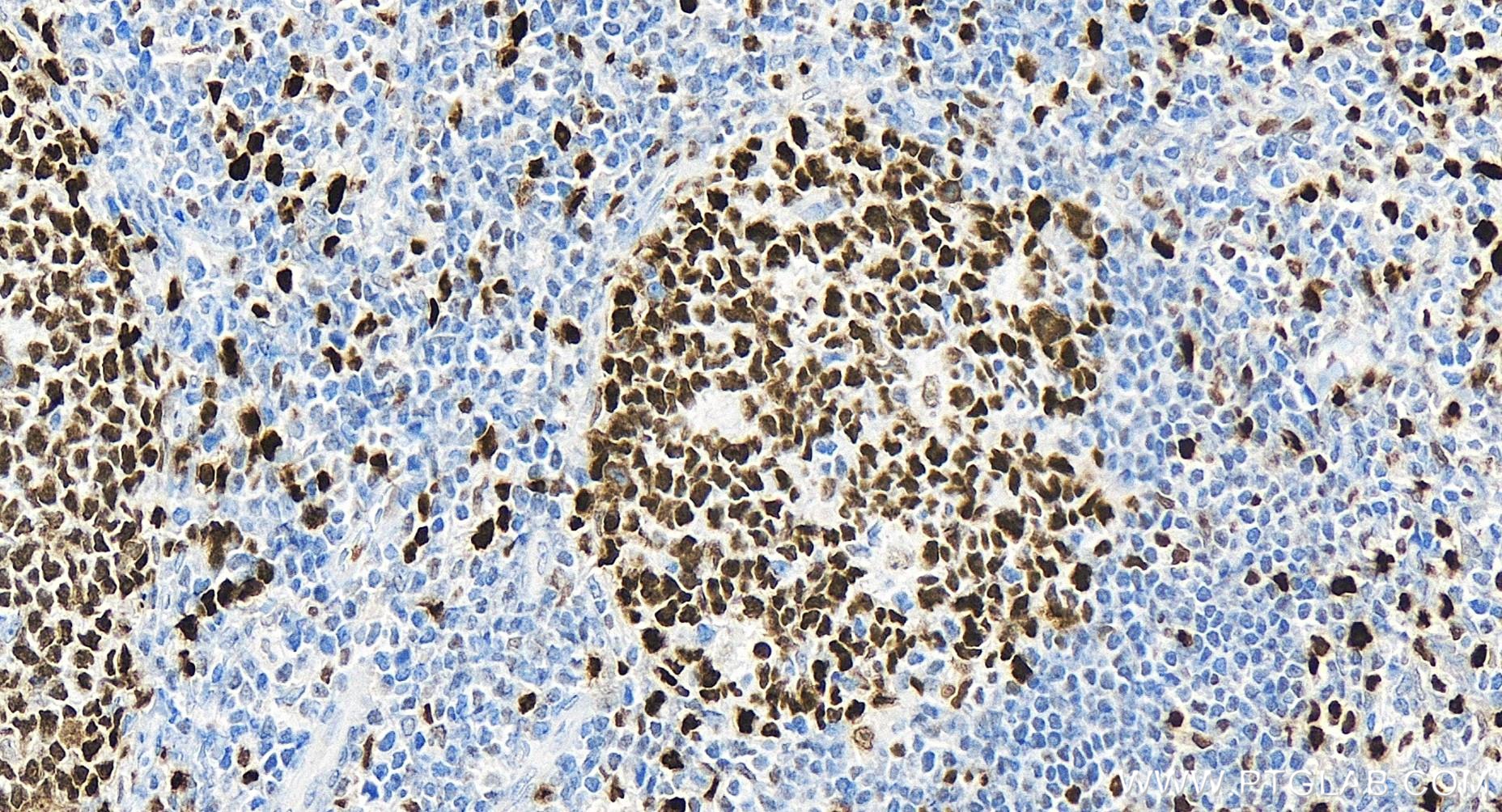 IHC staining of human tonsillitis using 84511-2-RR (same clone as 84511-2-PBS)