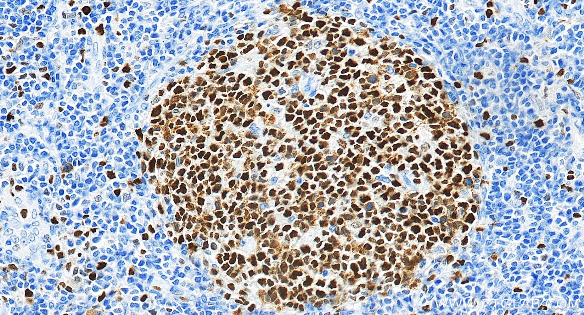 IHC staining of human tonsillitis using 84511-5-RR