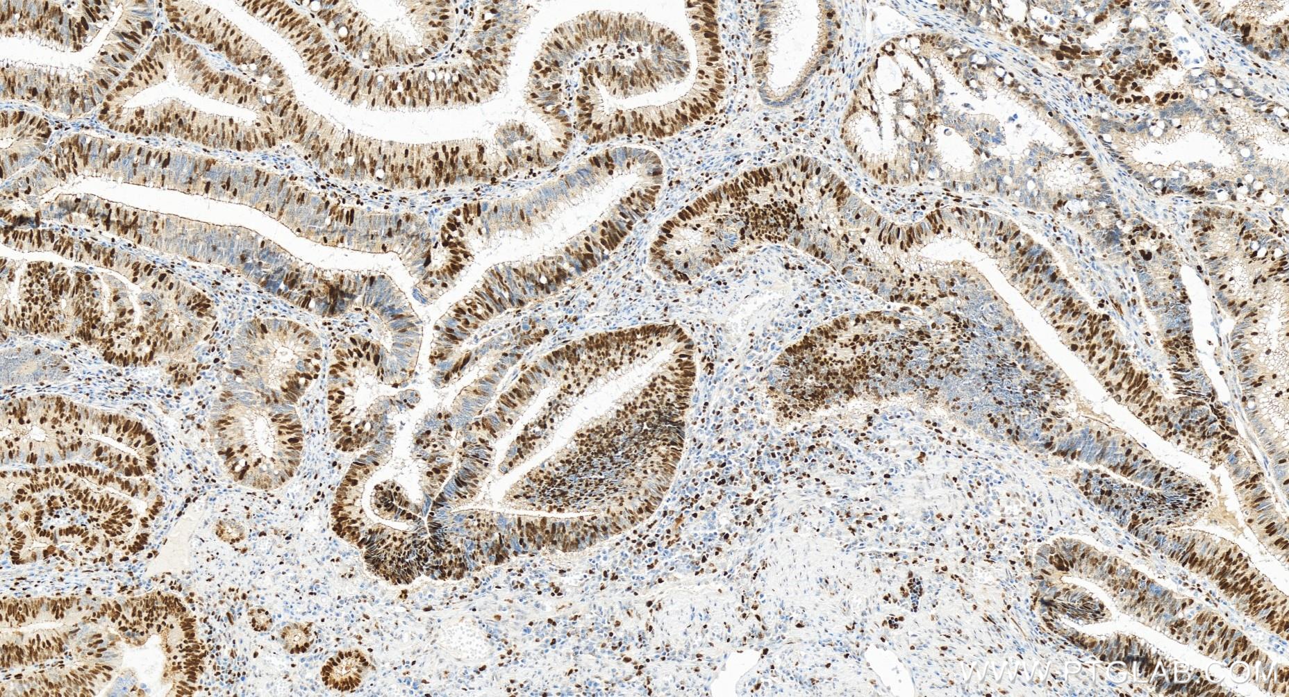 IHC staining of human colon cancer using 84792-5-RR