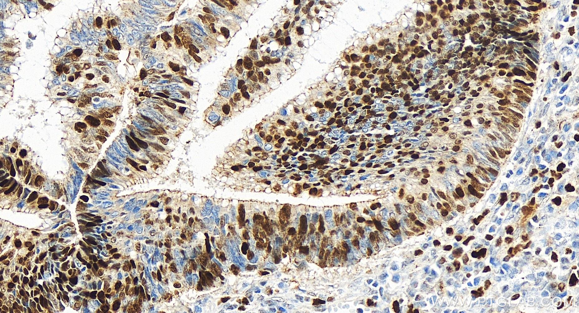 IHC staining of human colon cancer using 84792-5-RR