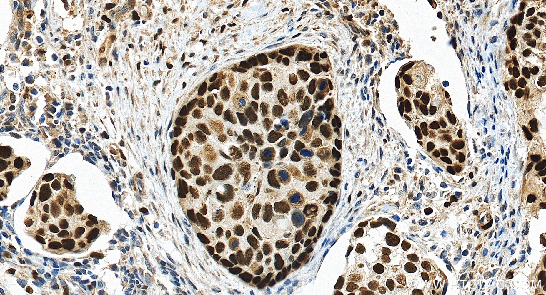 IHC staining of human cervical cancer using 86950-1-RR IHC staining of human cervical cancer using 86950-1-RR