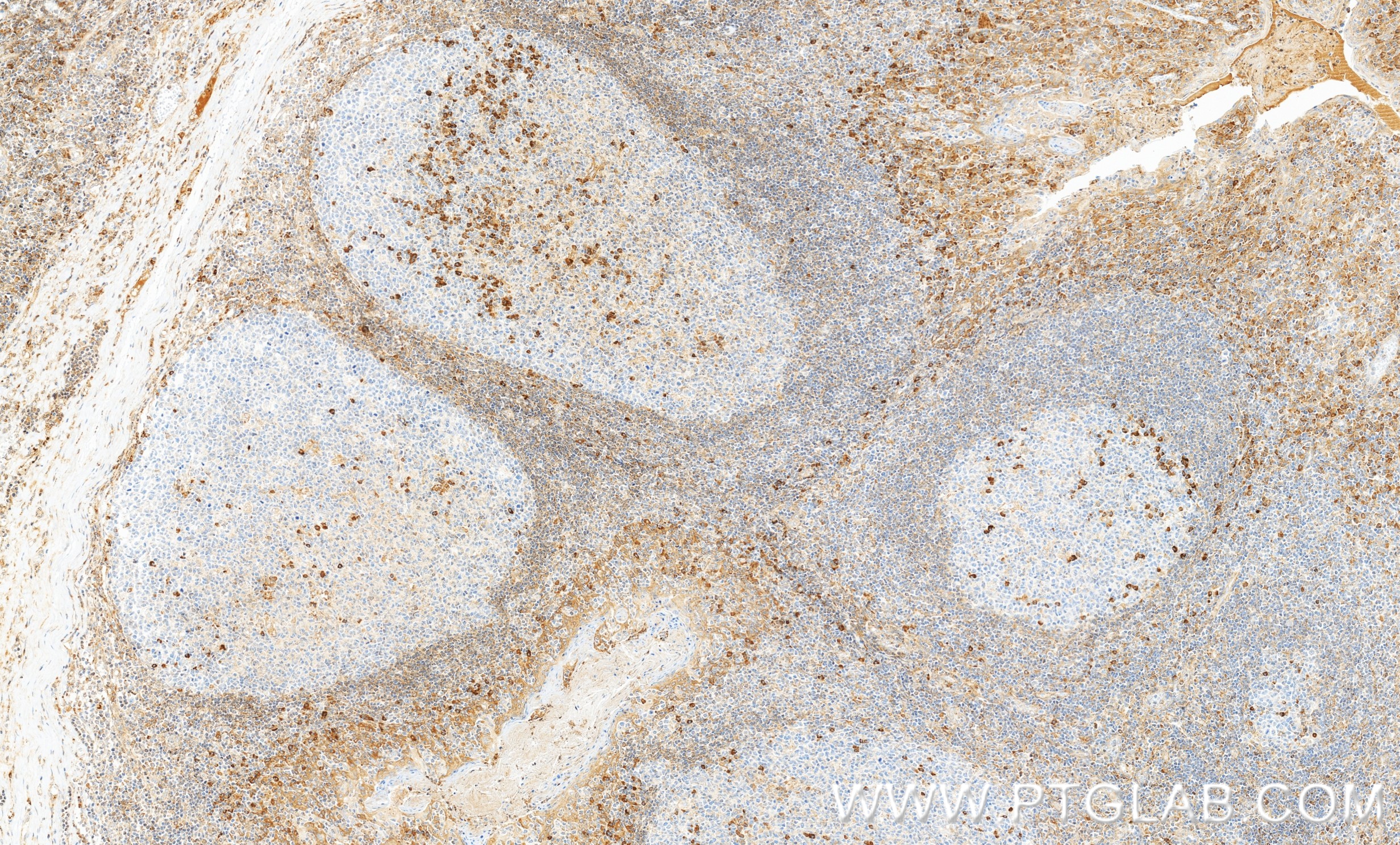 IHC staining of human tonsillitis using 86202-1-RR (same clone as 86202-1-PBS) IHC staining of human tonsillitis using 86202-1-RR (same clone as 86202-1-PBS)