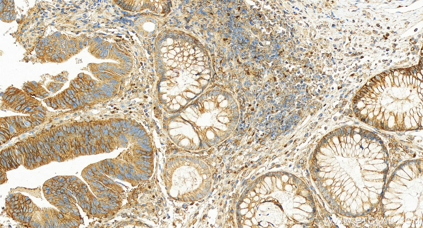 Immunohistochemical analysis of paraffin-embedded human colon cancer tissue slide using 20139-1-AP (MCT1 antibody) at dilution of 1:1600 (under 20x lens). Heat mediated antigen retrieval with Tris-EDTA buffer (pH 9.0). IHC staining of human colon cancer using 20139-1-AP