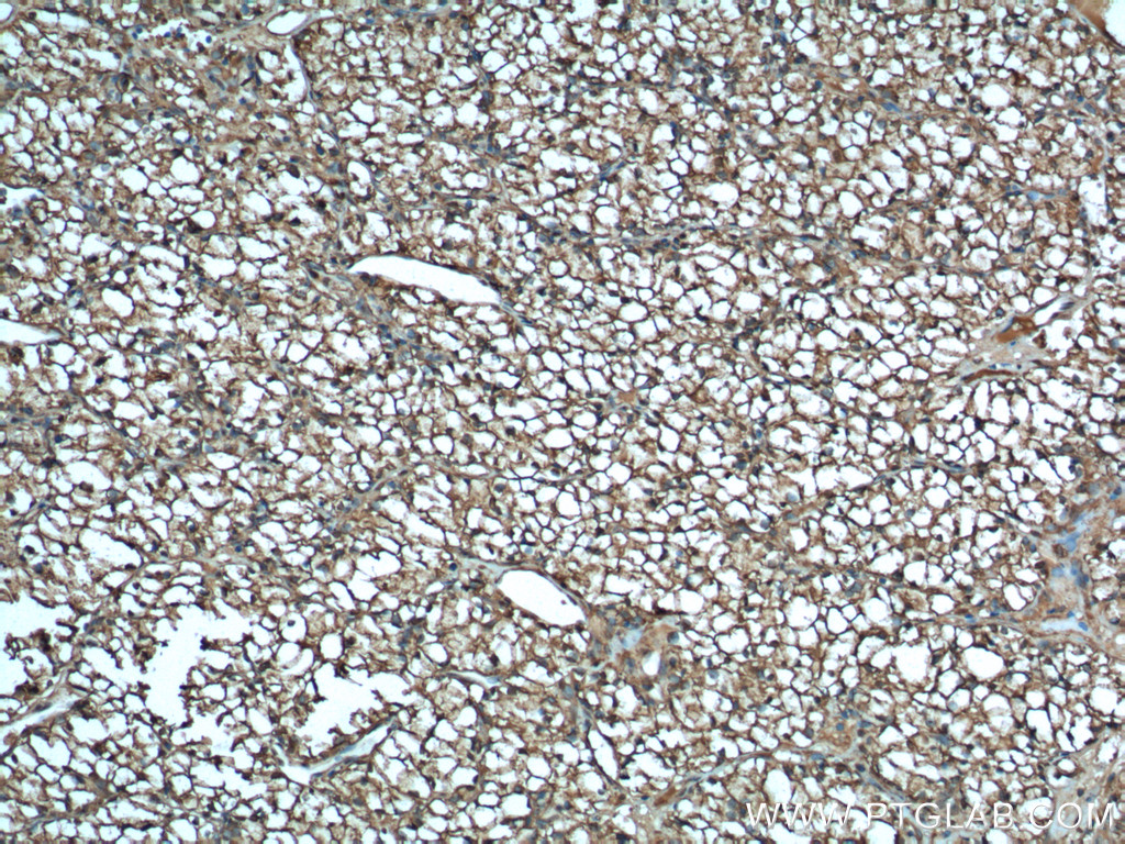 IHC staining of human renal cell carcinoma using 15904-1-AP