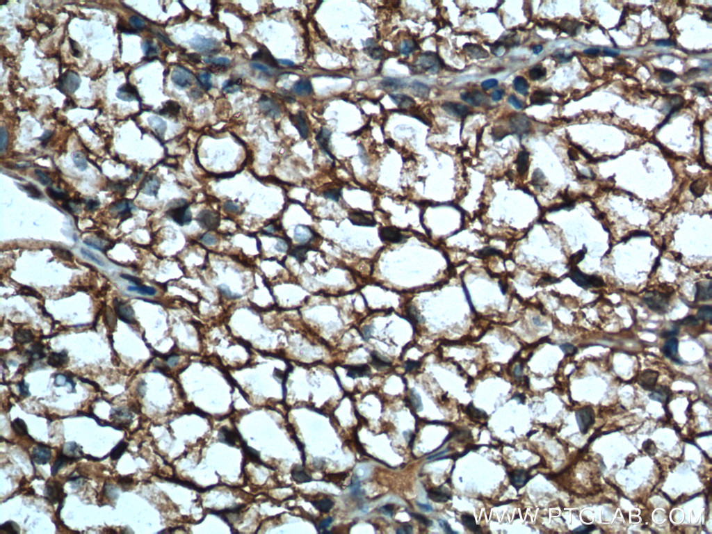 IHC staining of human renal cell carcinoma using 15904-1-AP