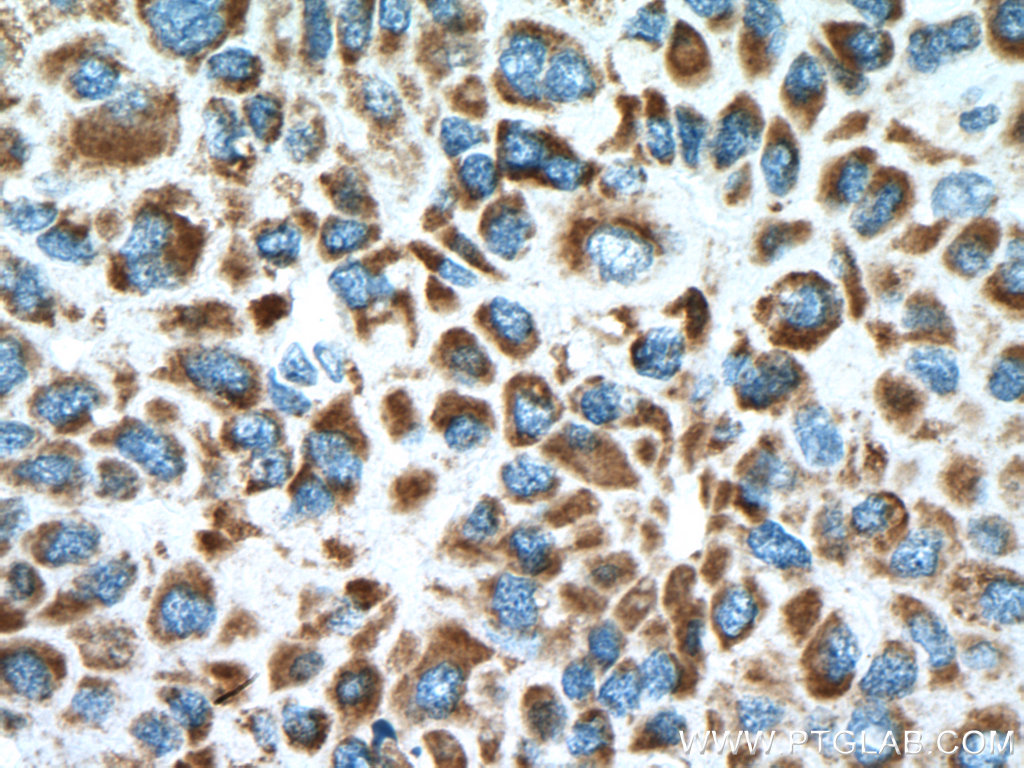 IHC staining of human liver cancer using 15462-1-AP