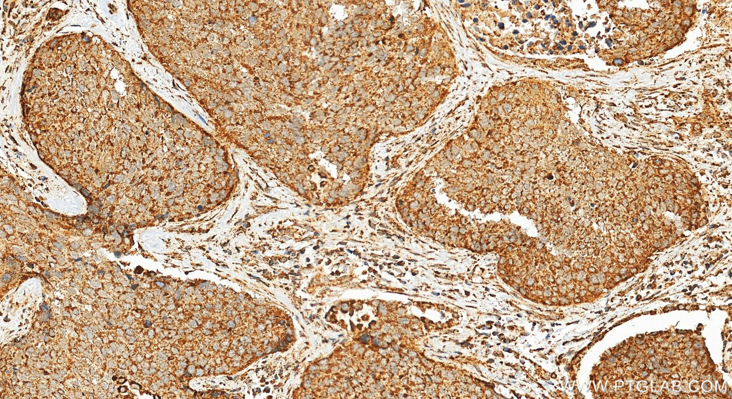 IHC staining of human lung cancer using 15462-1-AP