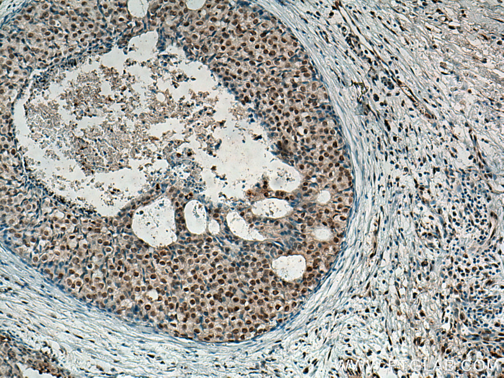 IHC staining of human breast cancer using 66511-1-Ig