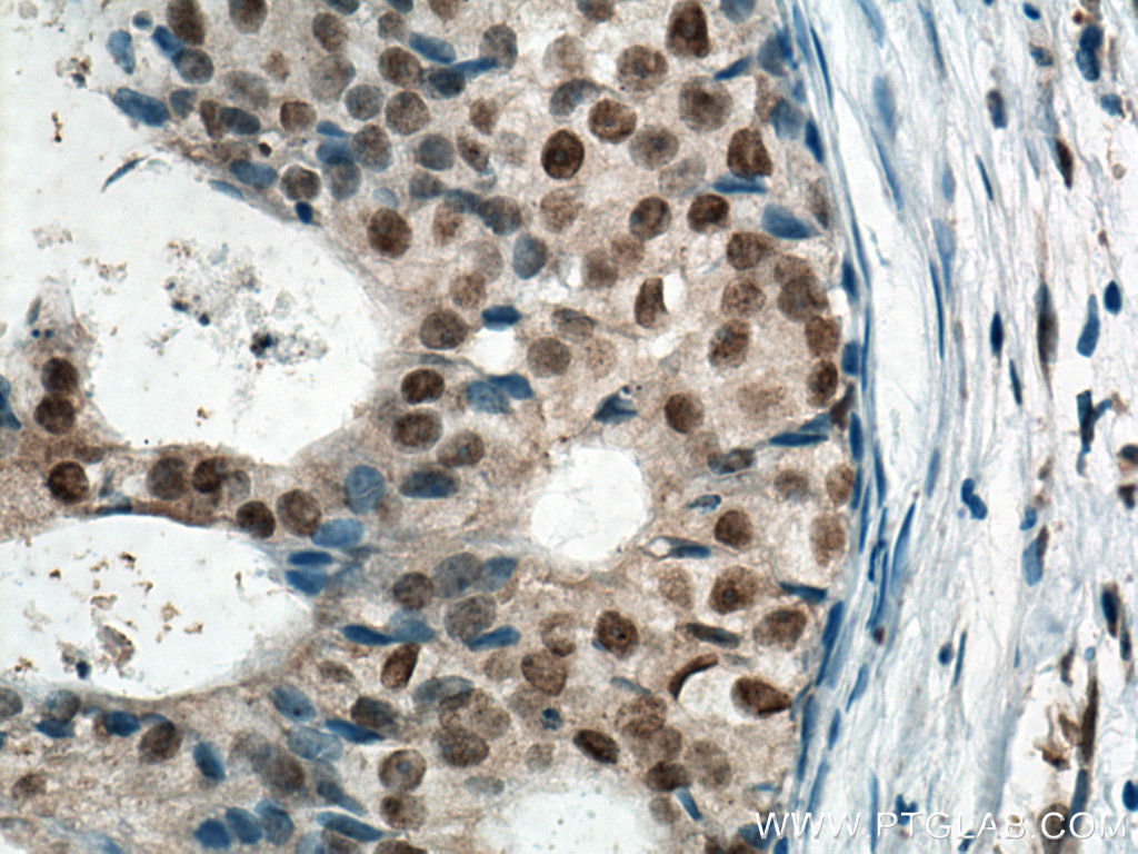 IHC staining of human breast cancer using 66511-1-Ig
