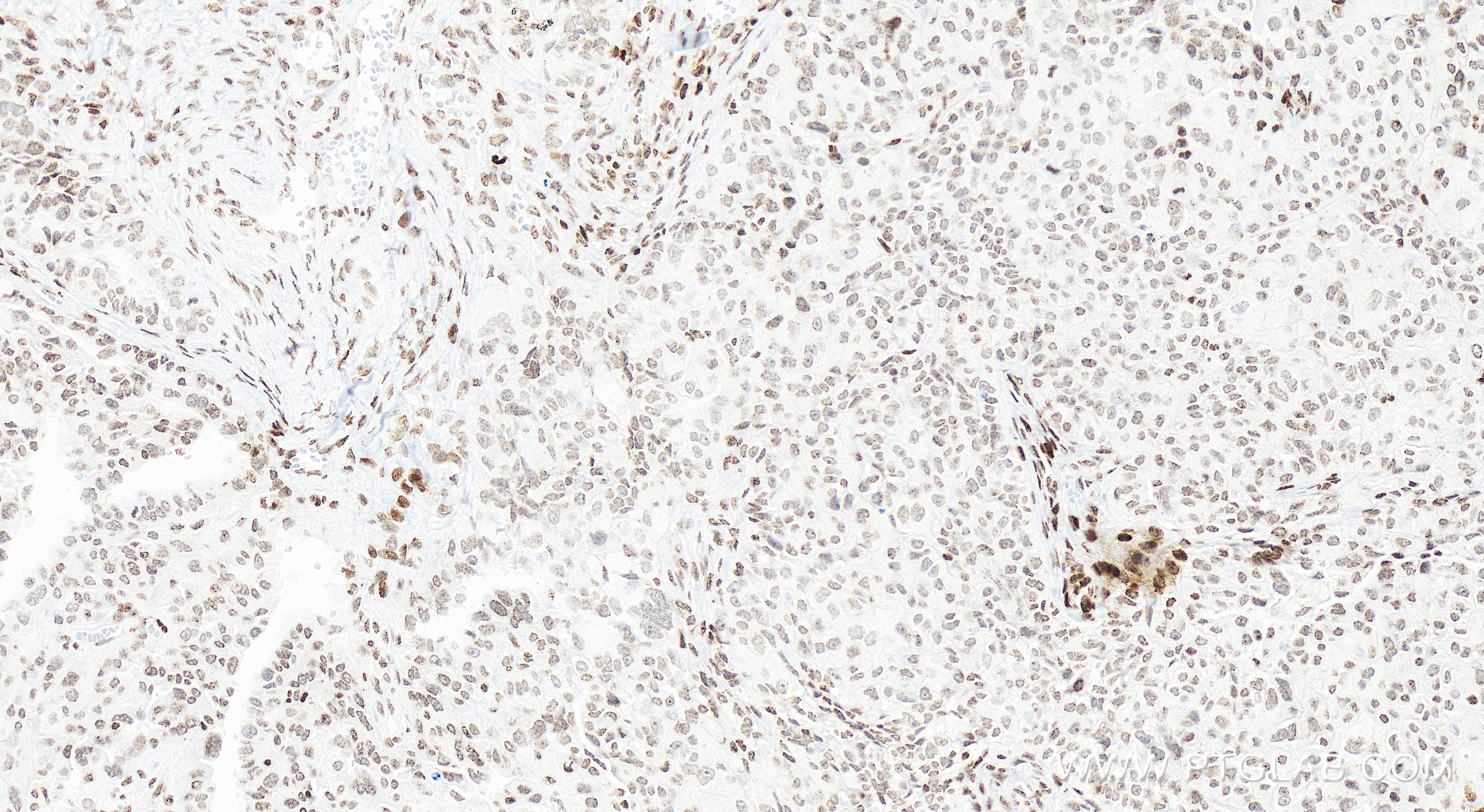 IHC staining of human ovary cancer using 84534-5-RR (same clone as 84534-5-PBS)